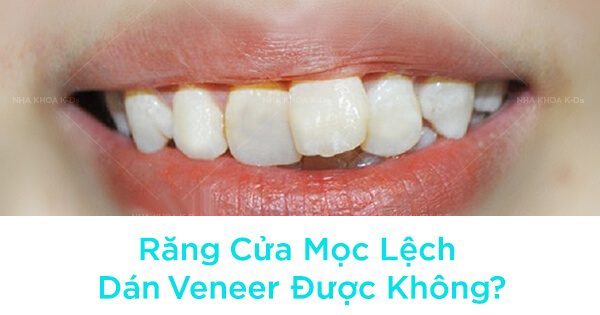 Răng Cửa Mọc Lệch Dán Veneer Được Không?