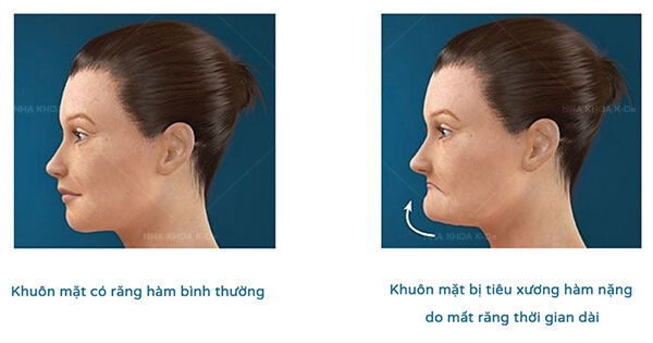 Giải Pháp Phục Hình Răng Khi Bị Tiêu Xương Hàm