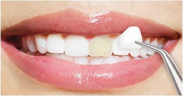 Răng sứ Veneer liệu có phải là sự lựa chọn tốt không?