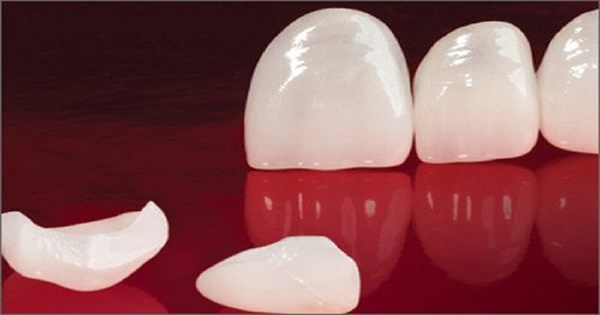 Quy trình dán răng sứ Veneer tại Nha Khoa SEN