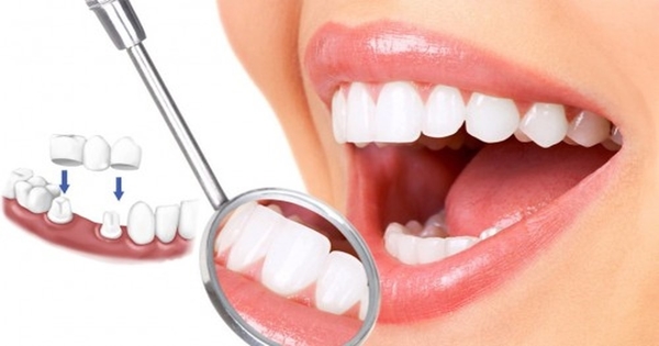 Tìm hiểu quy trình bọc răng sứ tại Nha Khoa SEN