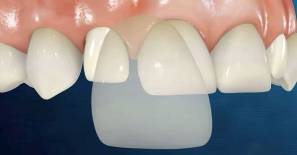 Hậu quả của việc dán răng sứ Veneer sai kỹ thuật