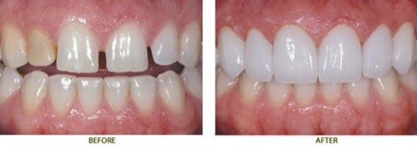 Răng nào thích hợp sử dụng mặt dán sứ Veneer